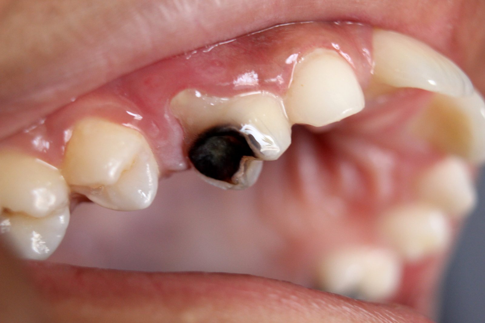 Rotten Teeth: Causes, Symptoms and Treatments