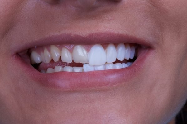 Composite Veneers: What You Need to Know